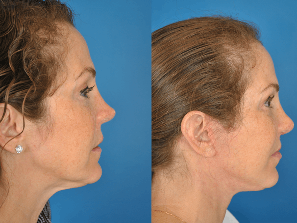 Rhinoplasty Before & After Gallery - Patient 177570573 - Image 1