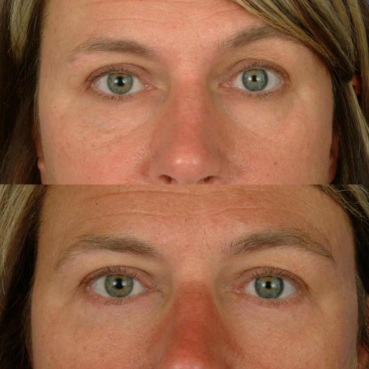Eyelifts & Blepharoplasty Before & After Gallery - Patient 177570576 - Image 2