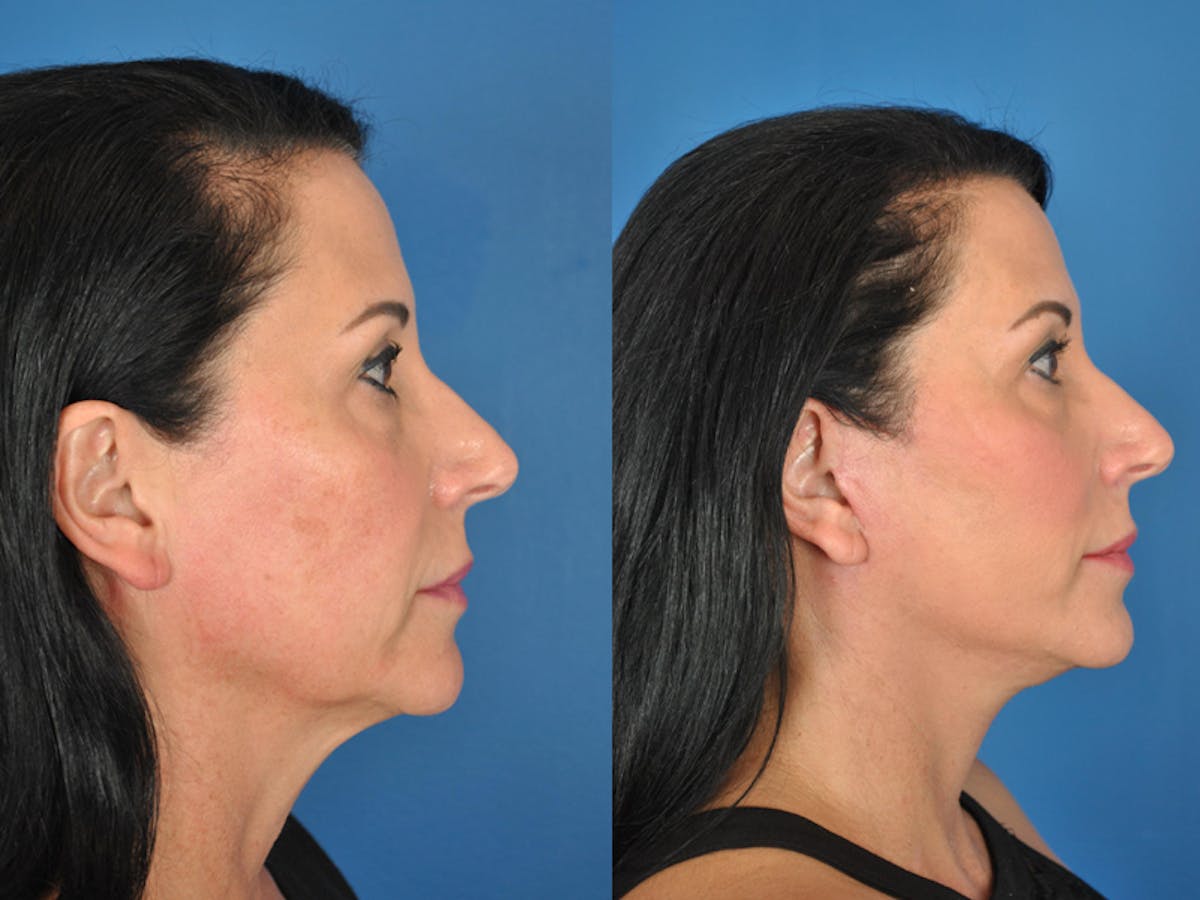 Facelifts Before & After Gallery - Patient 177570575 - Image 2