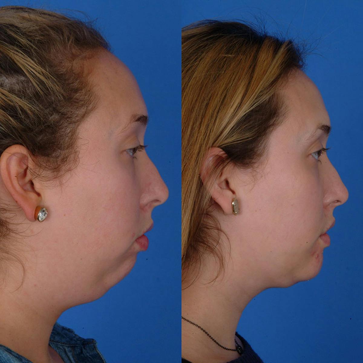 Chin Augmentation Before & After Gallery - Patient 177570577 - Image 1