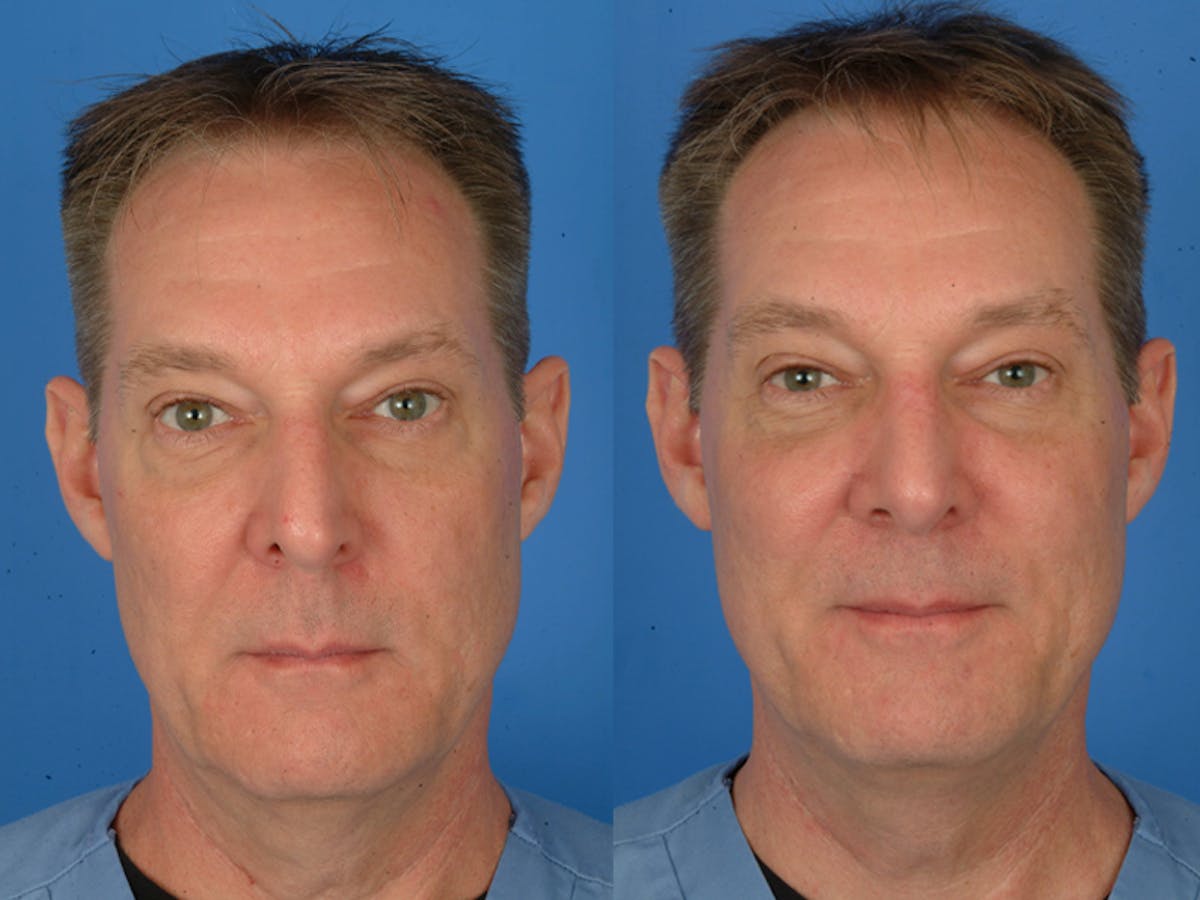 Rhinoplasty Before & After Gallery - Patient 177570579 - Image 2