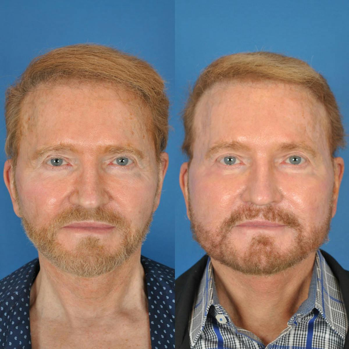 Laser Skin Resurfacing Before & After Gallery - Patient 177571157 - Image 1