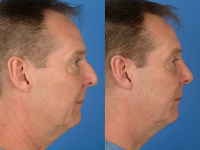 Rhinoplasty Before & After Gallery - Patient 177570579 - Image 1