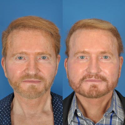 Facelifts Before & After Gallery - Patient 177570580 - Image 1