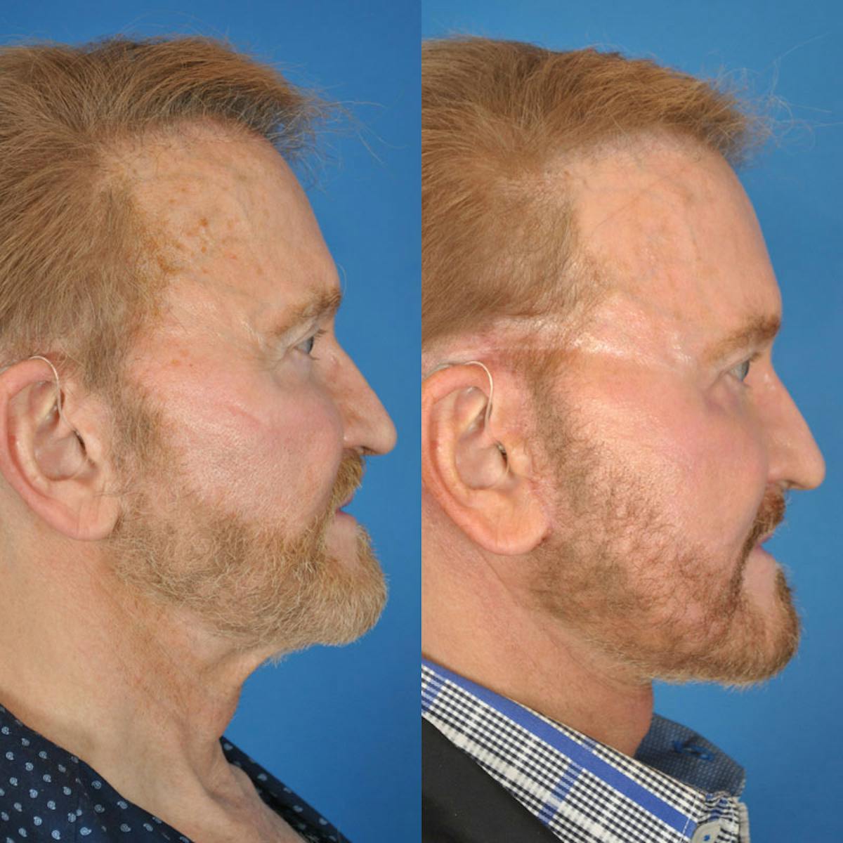Facelifts Before & After Gallery - Patient 177570580 - Image 2