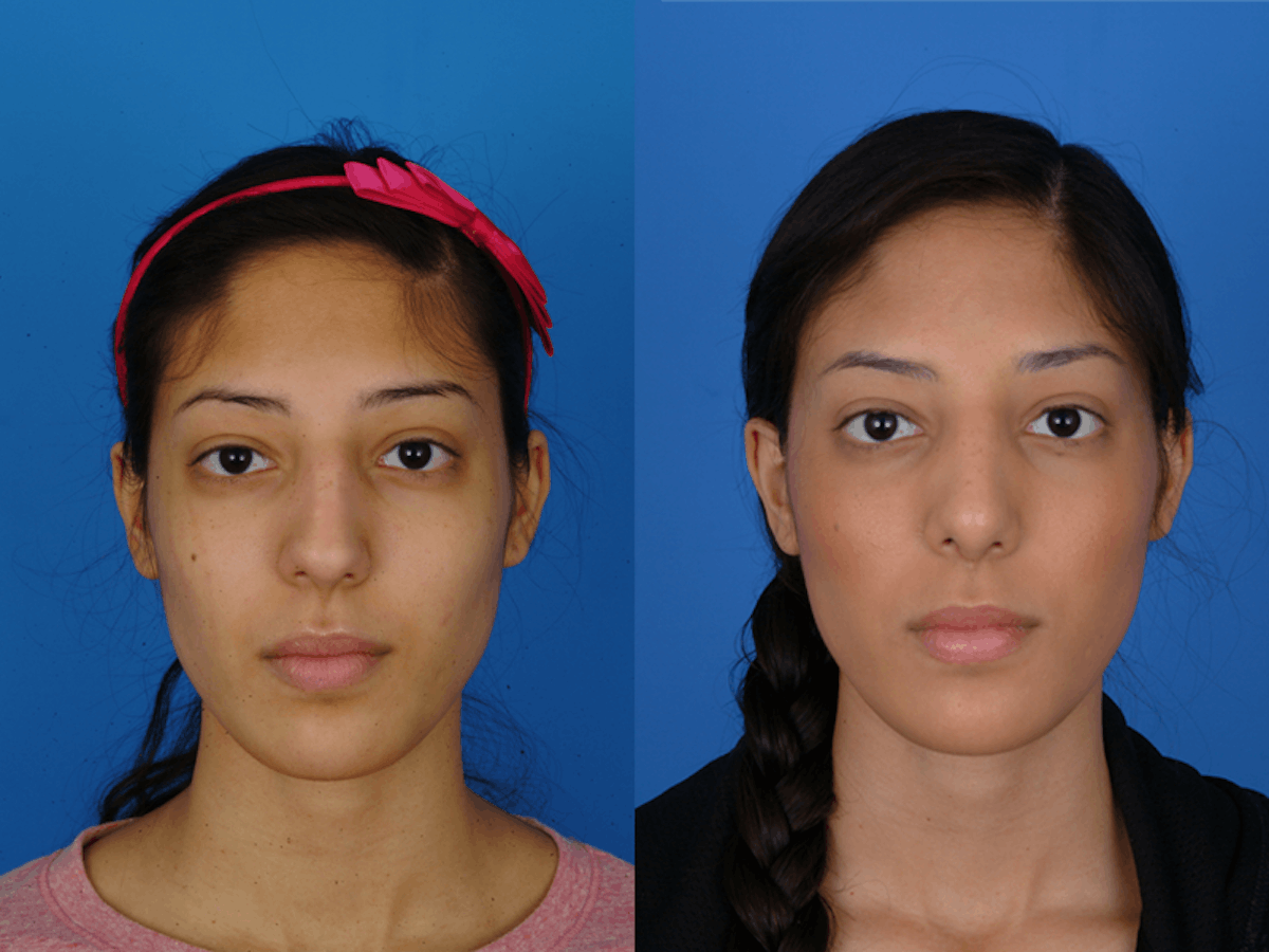 Rhinoplasty Before & After Gallery - Patient 177570584 - Image 2