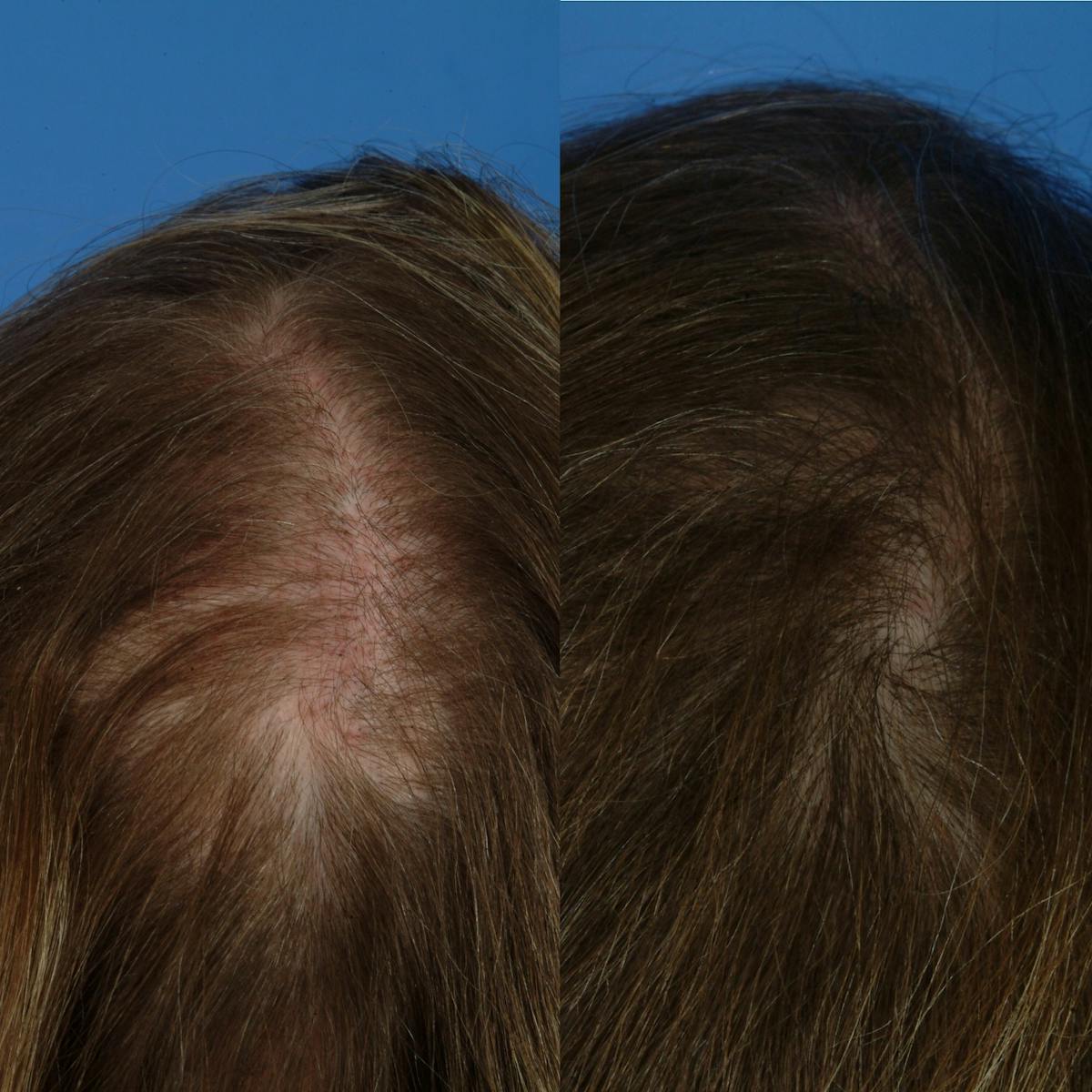 Hair Restoration Before & After Gallery - Patient 177570583 - Image 1