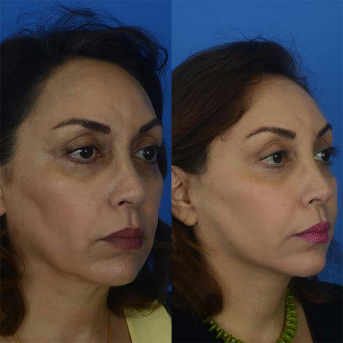 Facelifts Before & After Gallery - Patient 177570586 - Image 2