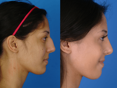 Rhinoplasty Before & After Gallery - Patient 177570584 - Image 1