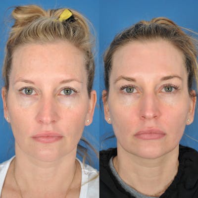 Laser Skin Resurfacing Before & After Gallery - Patient 177571154 - Image 1