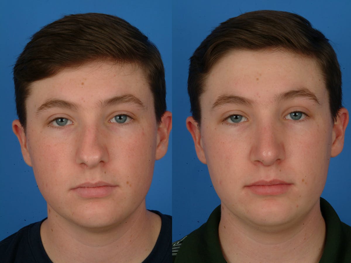 Rhinoplasty Before & After Gallery - Patient 177570590 - Image 2