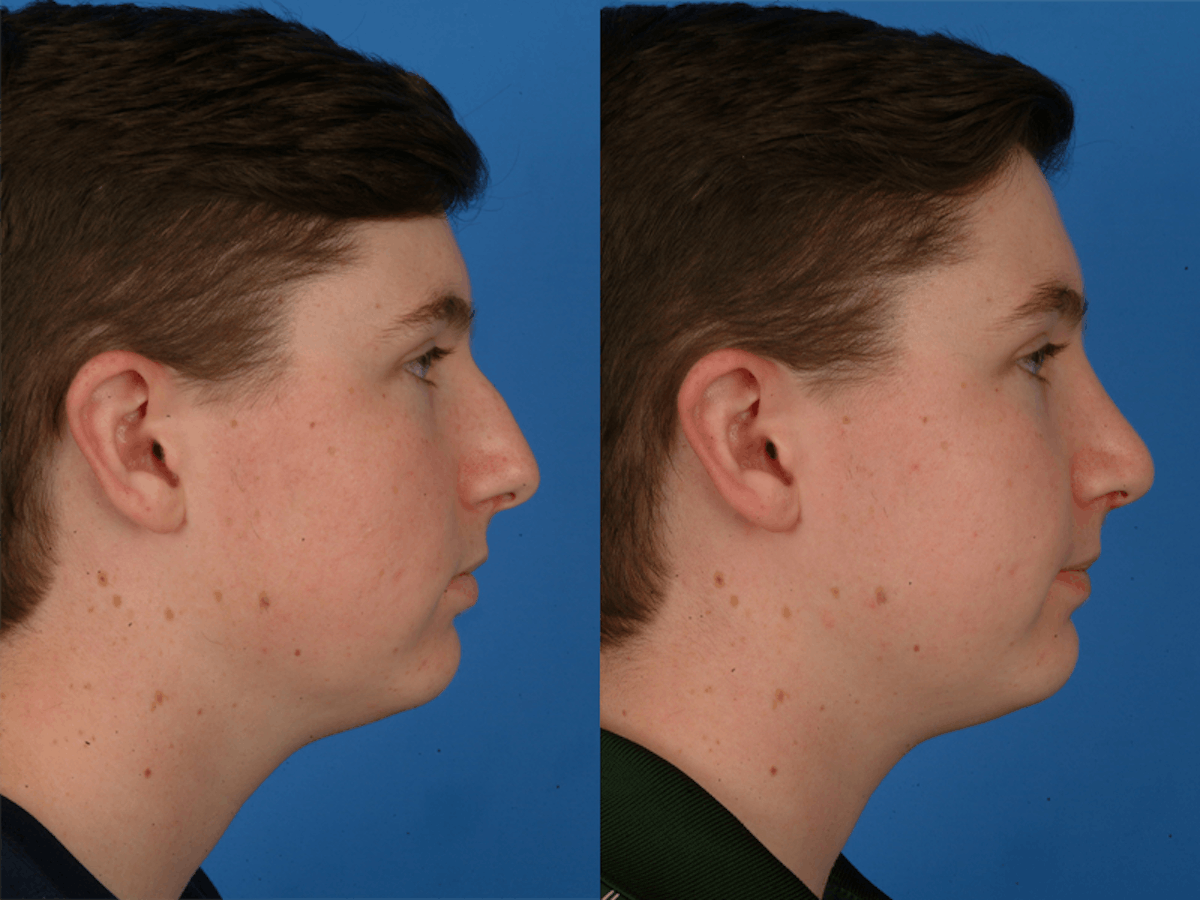 Rhinoplasty Before & After Gallery - Patient 177570590 - Image 2