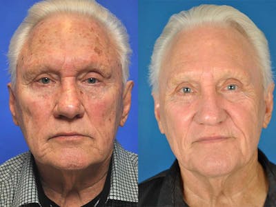 Laser Skin Resurfacing Before & After Gallery - Patient 177571156 - Image 1