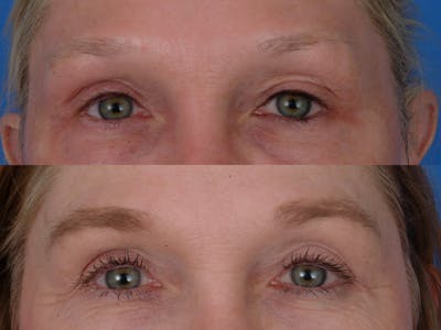 Eyebrow Transplant Before & After Gallery - Patient 180185527 - Image 1