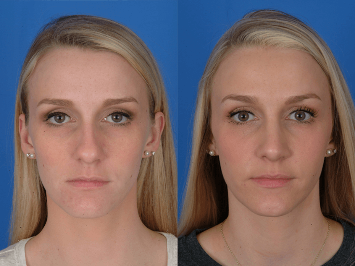 Rhinoplasty Before & After Gallery - Patient 177570593 - Image 2
