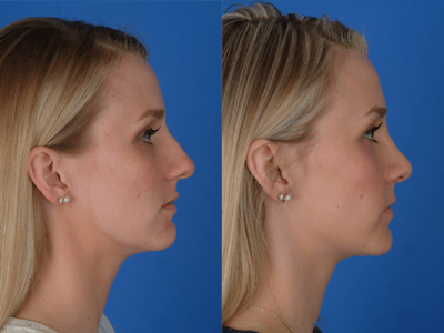 Rhinoplasty Before & After Gallery - Patient 177570593 - Image 1
