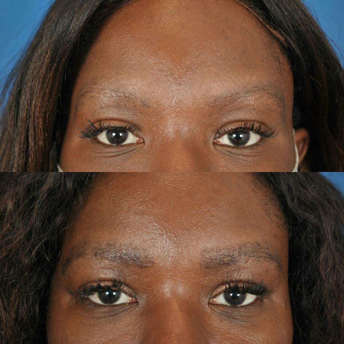 Eyebrow Transplant Before & After Gallery - Patient 180185533 - Image 1