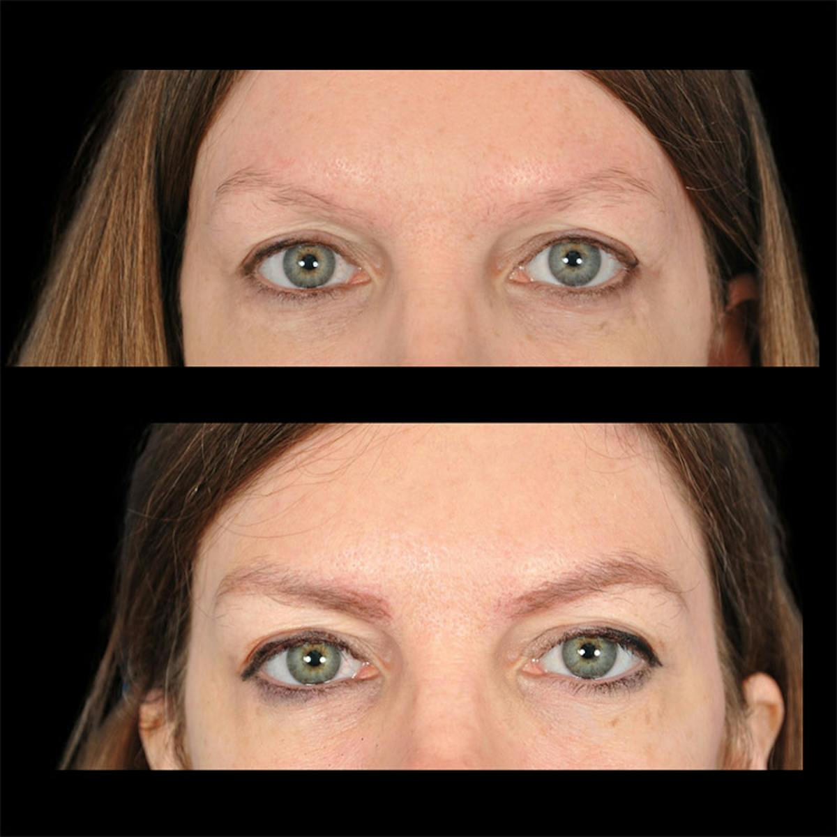 Eyebrow Transplant Before & After Gallery - Patient 180185538 - Image 1