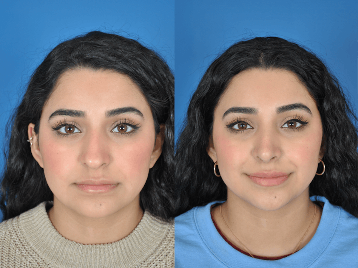 Rhinoplasty Before & After Gallery - Patient 177570616 - Image 2