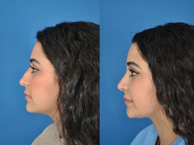 Rhinoplasty Before & After Gallery - Patient 177570616 - Image 1