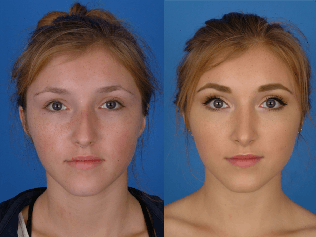 Rhinoplasty Before & After Gallery - Patient 177570617 - Image 2