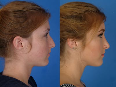 Rhinoplasty Before & After Gallery - Patient 177570617 - Image 1