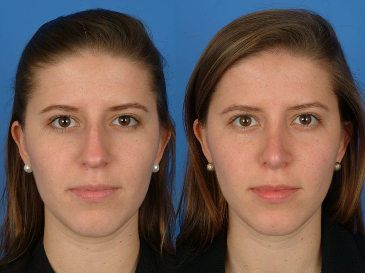 Rhinoplasty Before & After Gallery - Patient 177570632 - Image 2