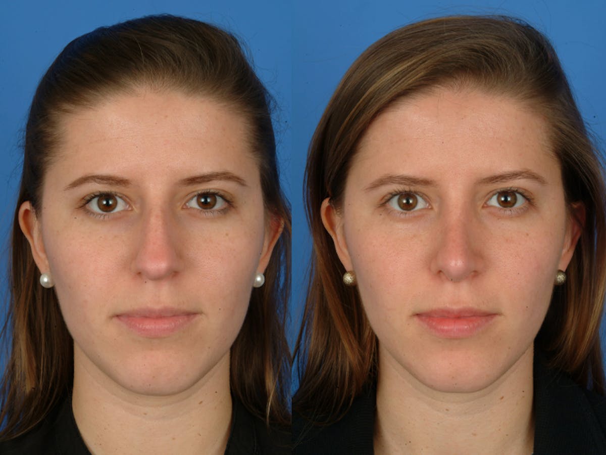 Rhinoplasty Before & After Gallery - Patient 177570632 - Image 2