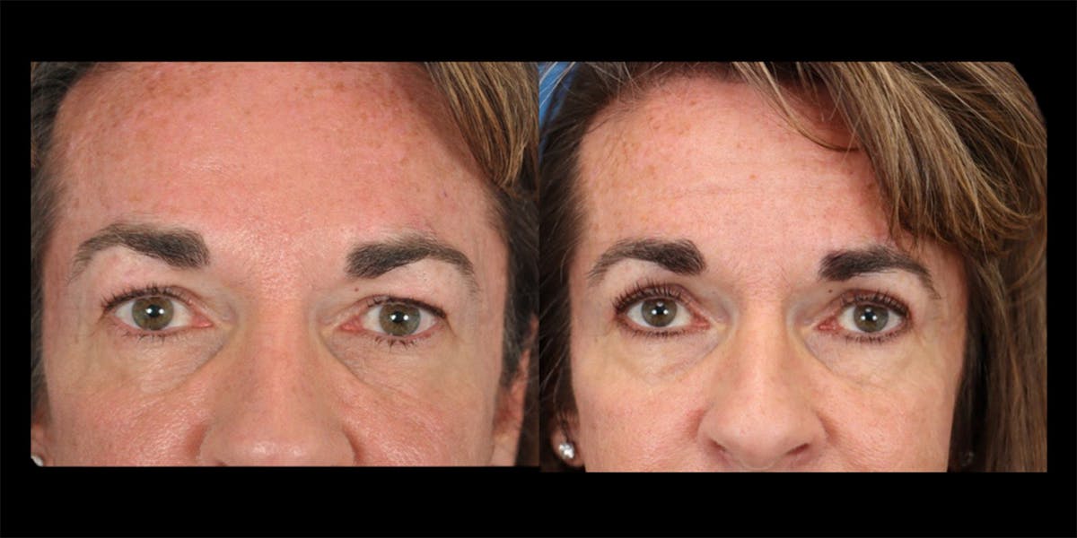 Eyelifts & Blepharoplasty Before & After Gallery - Patient 177570619 - Image 1