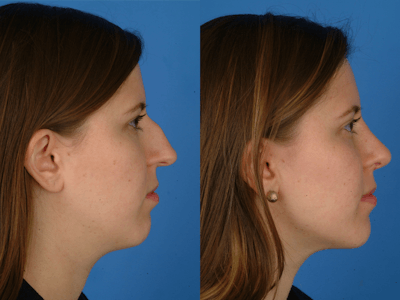 Rhinoplasty Before & After Gallery - Patient 177570632 - Image 1