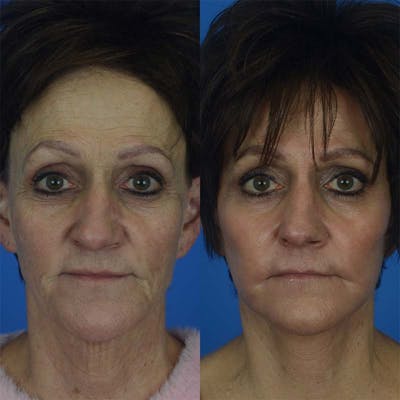 Laser Skin Resurfacing Before & After Gallery - Patient 177571158 - Image 1