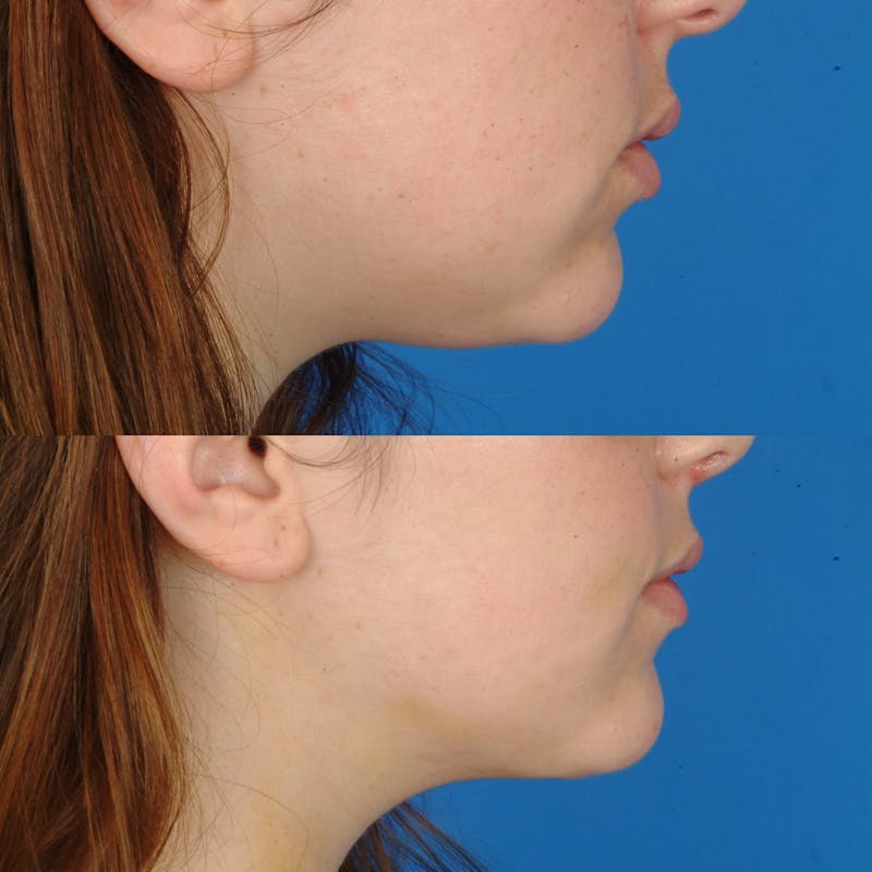 Submental Liposuction Before & After Gallery - Patient 179371105 - Image 2