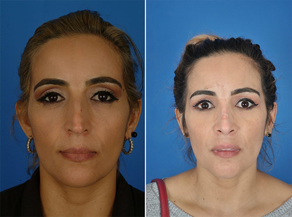 Rhinoplasty Before & After Gallery - Patient 179376997 - Image 2