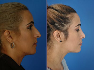 Rhinoplasty Before & After Gallery - Patient 179376997 - Image 1