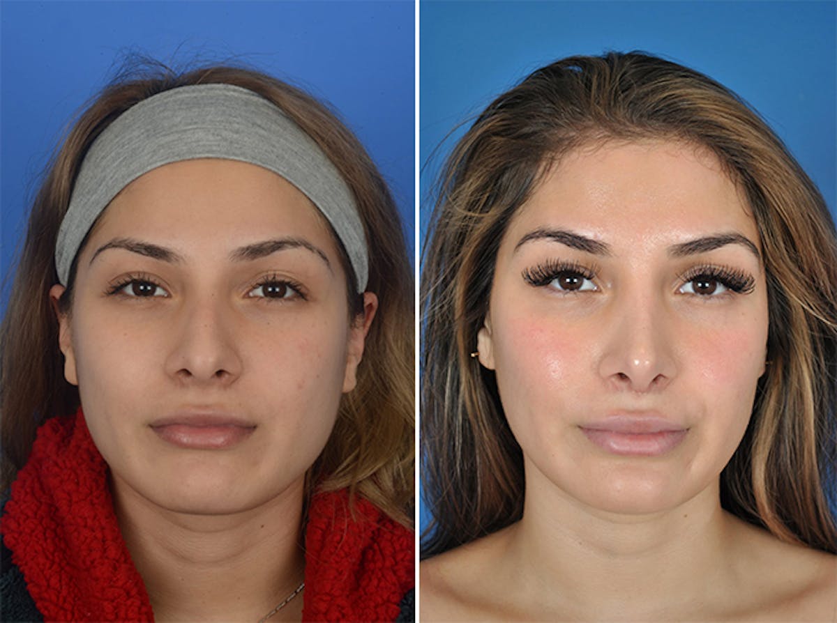 Rhinoplasty Before & After Gallery - Patient 179377267 - Image 2
