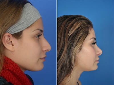 Rhinoplasty Before & After Gallery - Patient 179377267 - Image 1