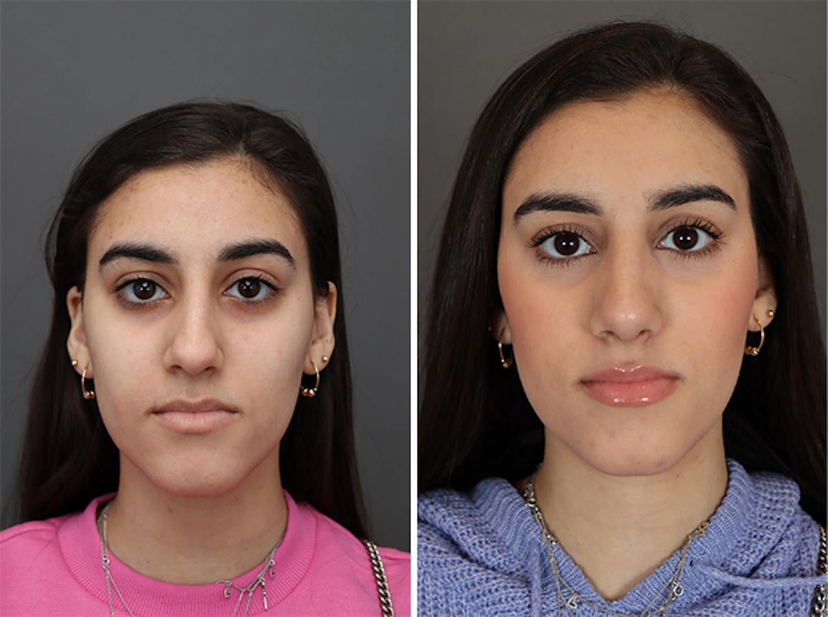 Rhinoplasty Before & After Gallery - Patient 179377268 - Image 2