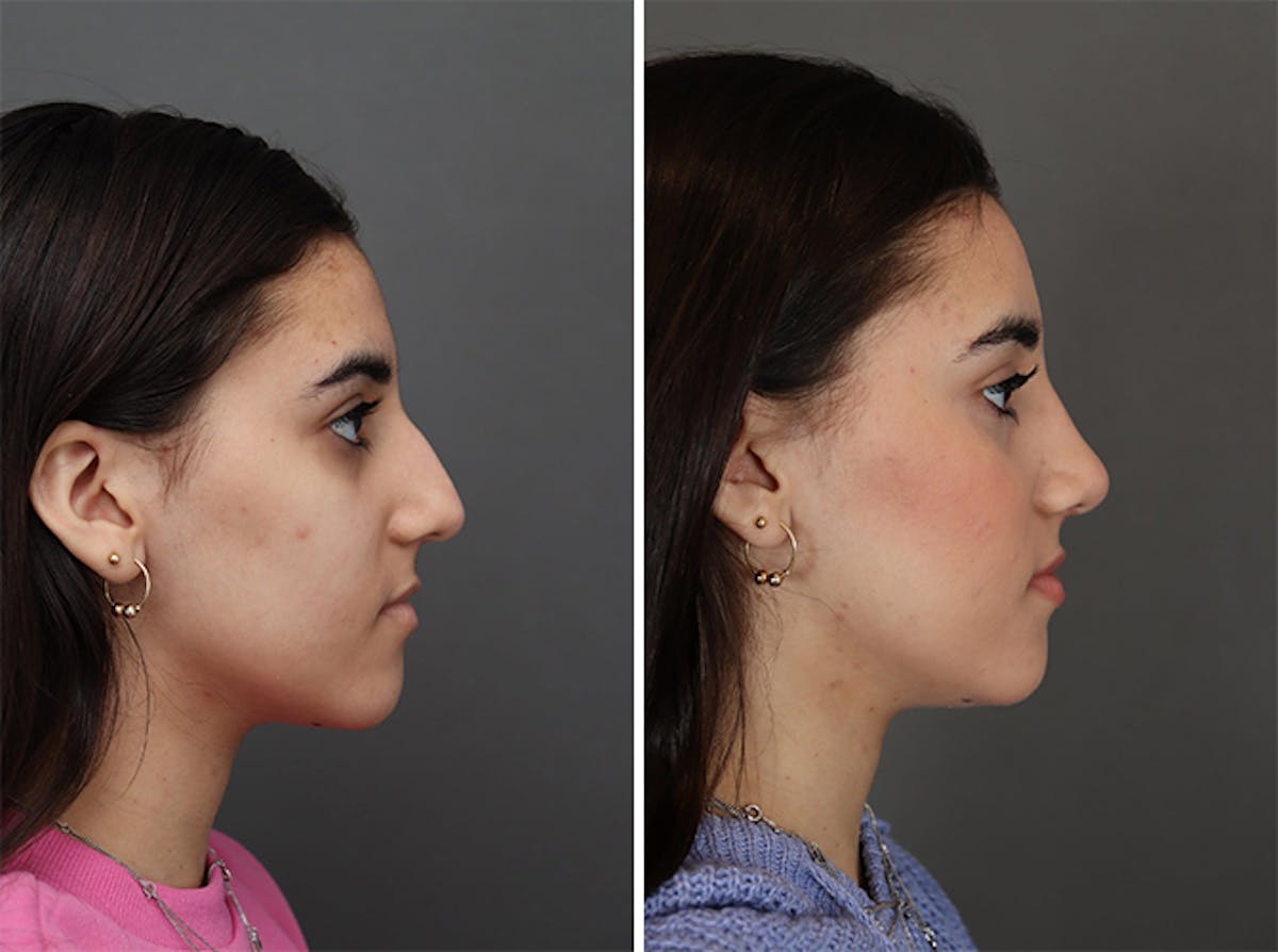 Rhinoplasty Before & After Gallery - Patient 179377268 - Image 1