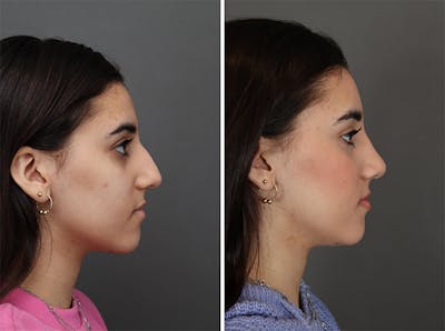 Rhinoplasty Before & After Gallery - Patient 179377268 - Image 1