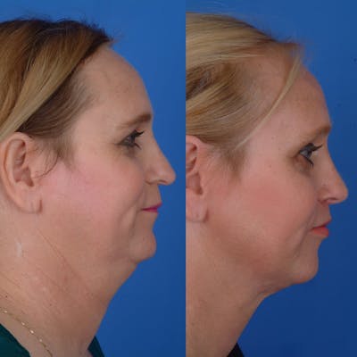 Rhinoplasty Before & After Gallery - Patient 179377269 - Image 1
