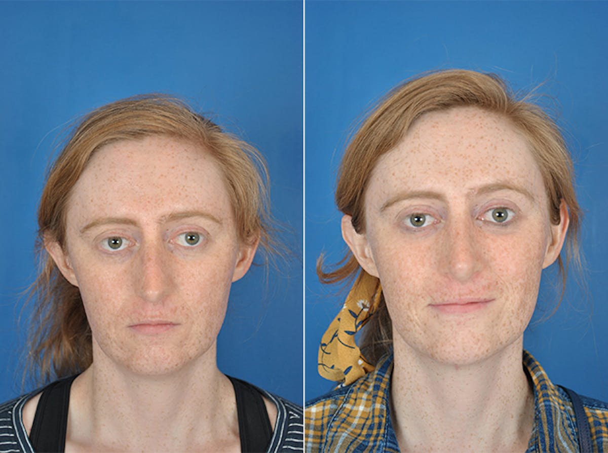 Rhinoplasty Before & After Gallery - Patient 179377270 - Image 3