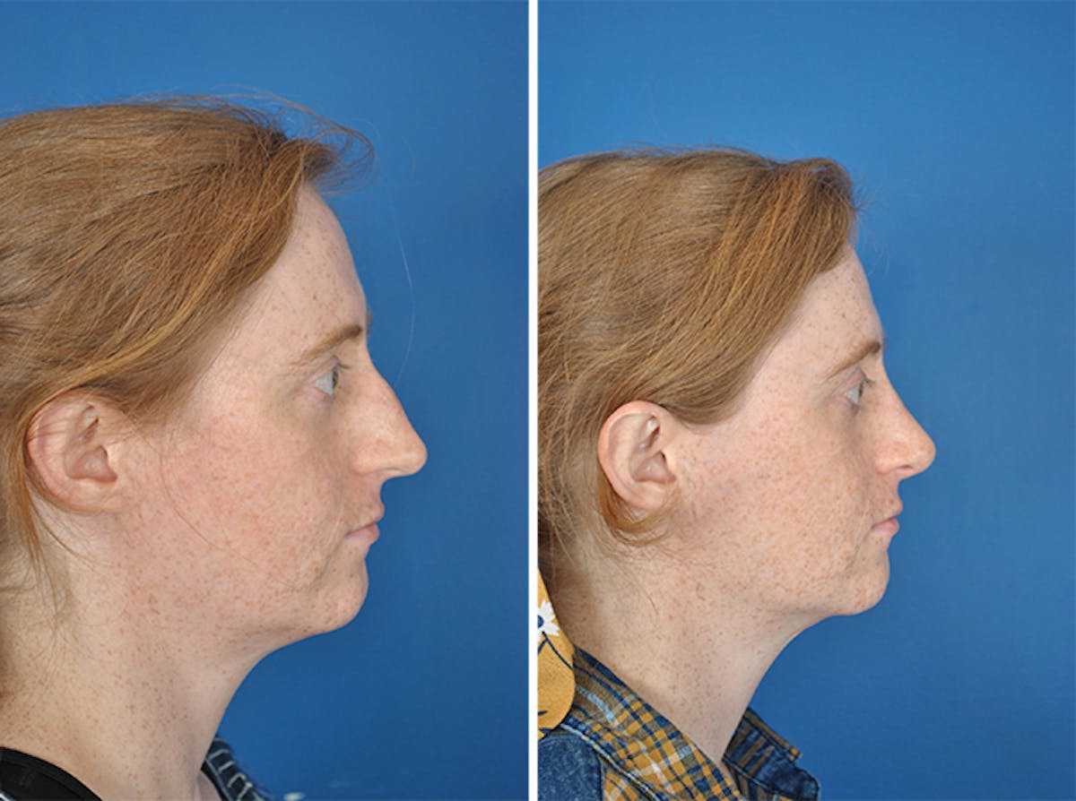 Rhinoplasty Before & After Gallery - Patient 179377270 - Image 2