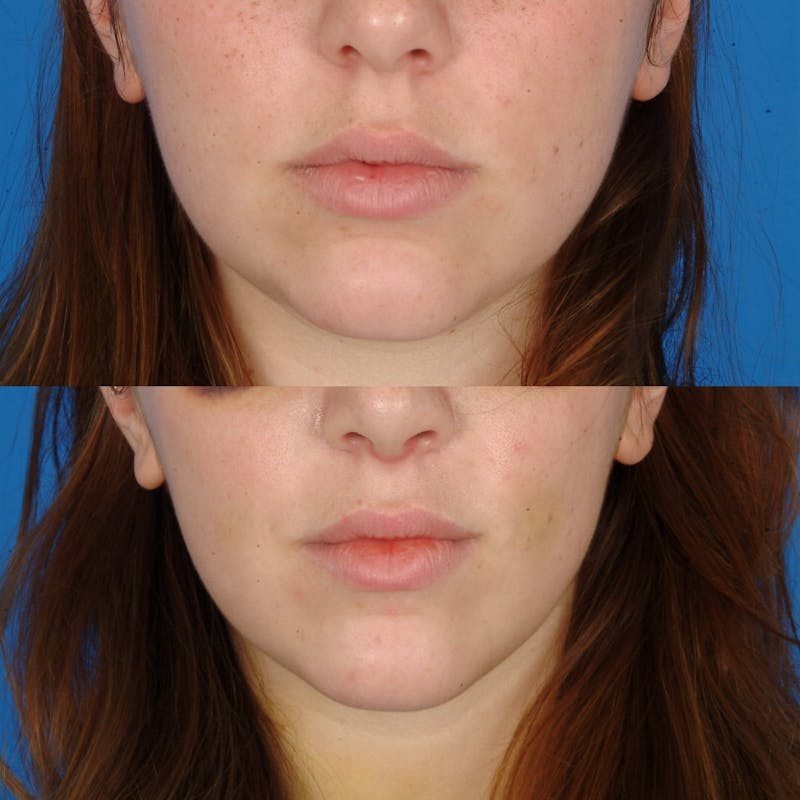 Submental Liposuction Before & After Gallery - Patient 179371105 - Image 1