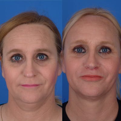 Facial Feminization Before & After Gallery - Patient 179746196 - Image 1