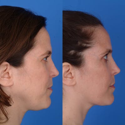 Submental Liposuction Before & After Gallery - Patient 179378247 - Image 1