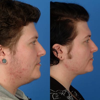 Submental Liposuction Before & After Gallery - Patient 179378246 - Image 2