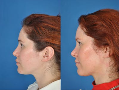 Rhinoplasty Before & After Gallery - Patient 179378918 - Image 1
