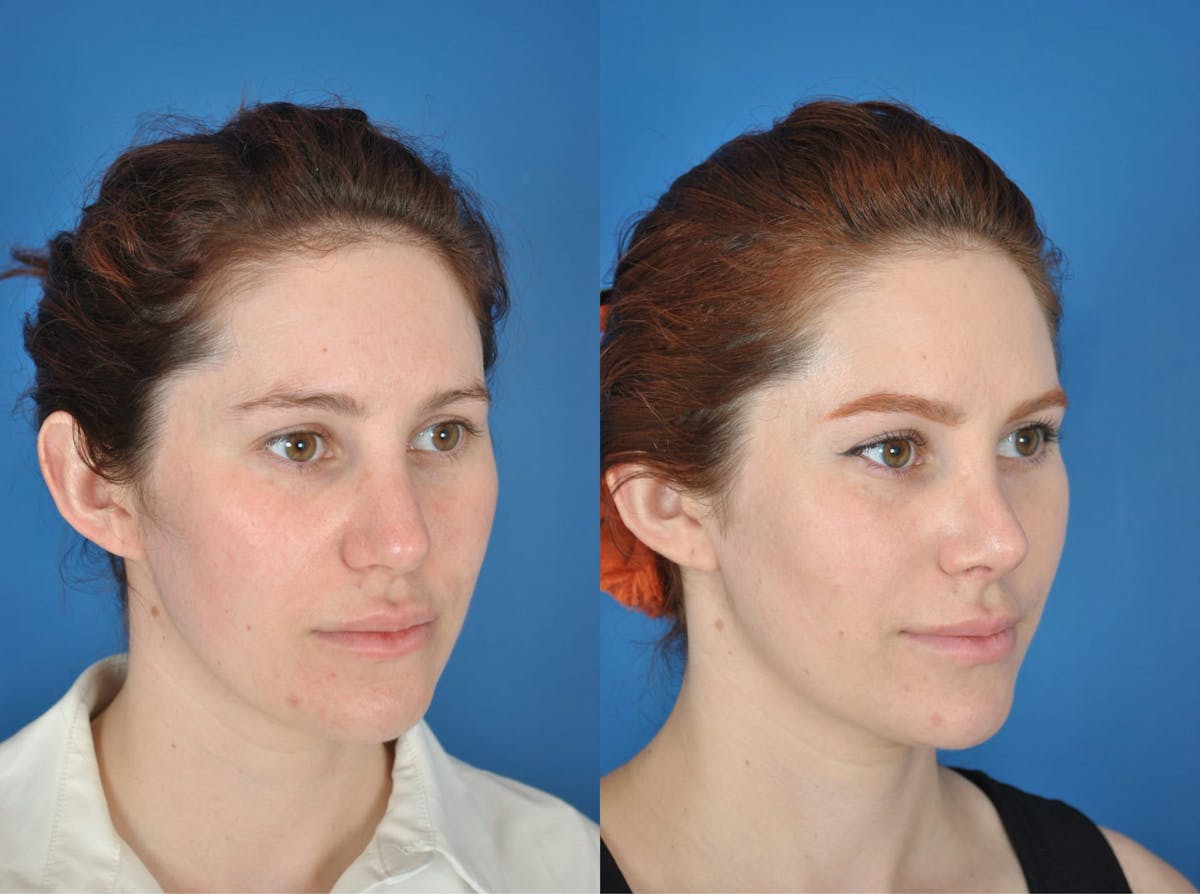 Rhinoplasty Before & After Gallery - Patient 179378918 - Image 2