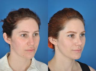 Submental Liposuction Before & After Gallery - Patient 179610049 - Image 2