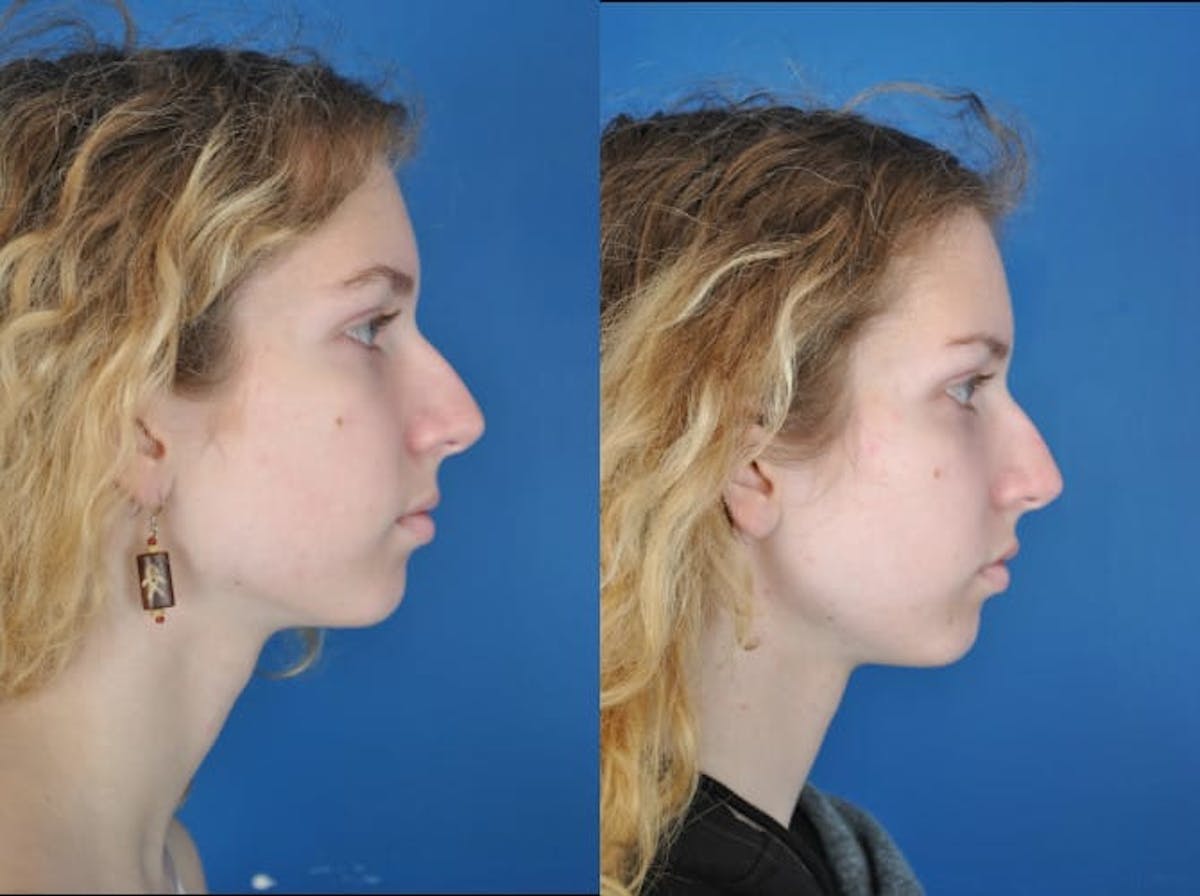 Facial Feminization Before & After Gallery - Patient 179748210 - Image 1